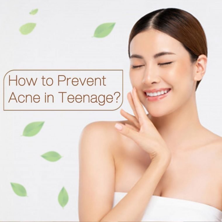 How-to-Prevent-Acne-in-Teenage.-(-Thumbnail-image)